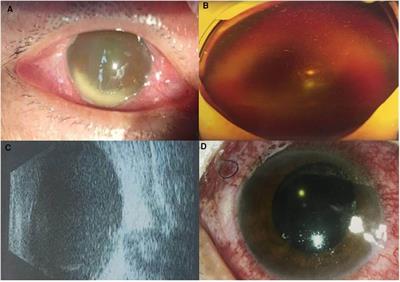 Vitrectomy using 0.025% povidone-iodine irrigation for treating post-traumatic endophthalmitis due to intraocular foreign bodies: Two case reports